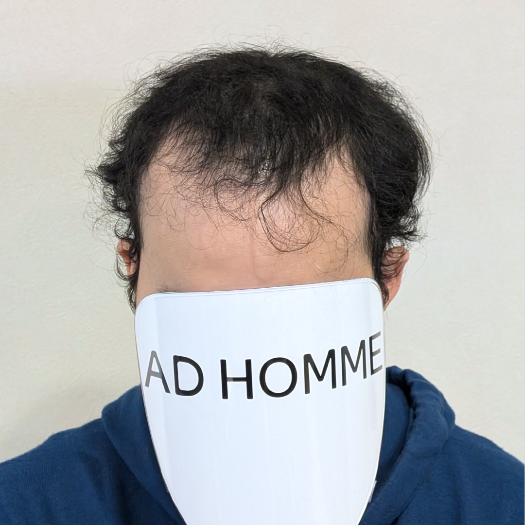 メンズウィッグ・かつら着用前写真【ブラウンメッシュナチュラルスタイル】